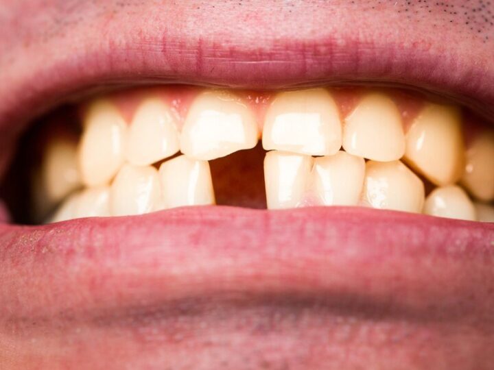 Złamany ząb – co robić? Porady dotyczące pękniętego szkliwa i uszkodzonych korzeni